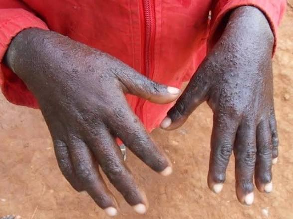 Scabies outbreak hit Hopley and Stoneridge
